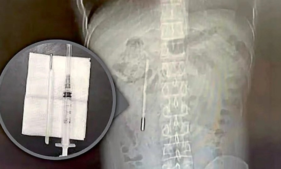 ২০ বছর ধরে তরুণের পেটে থার্মোমিটার